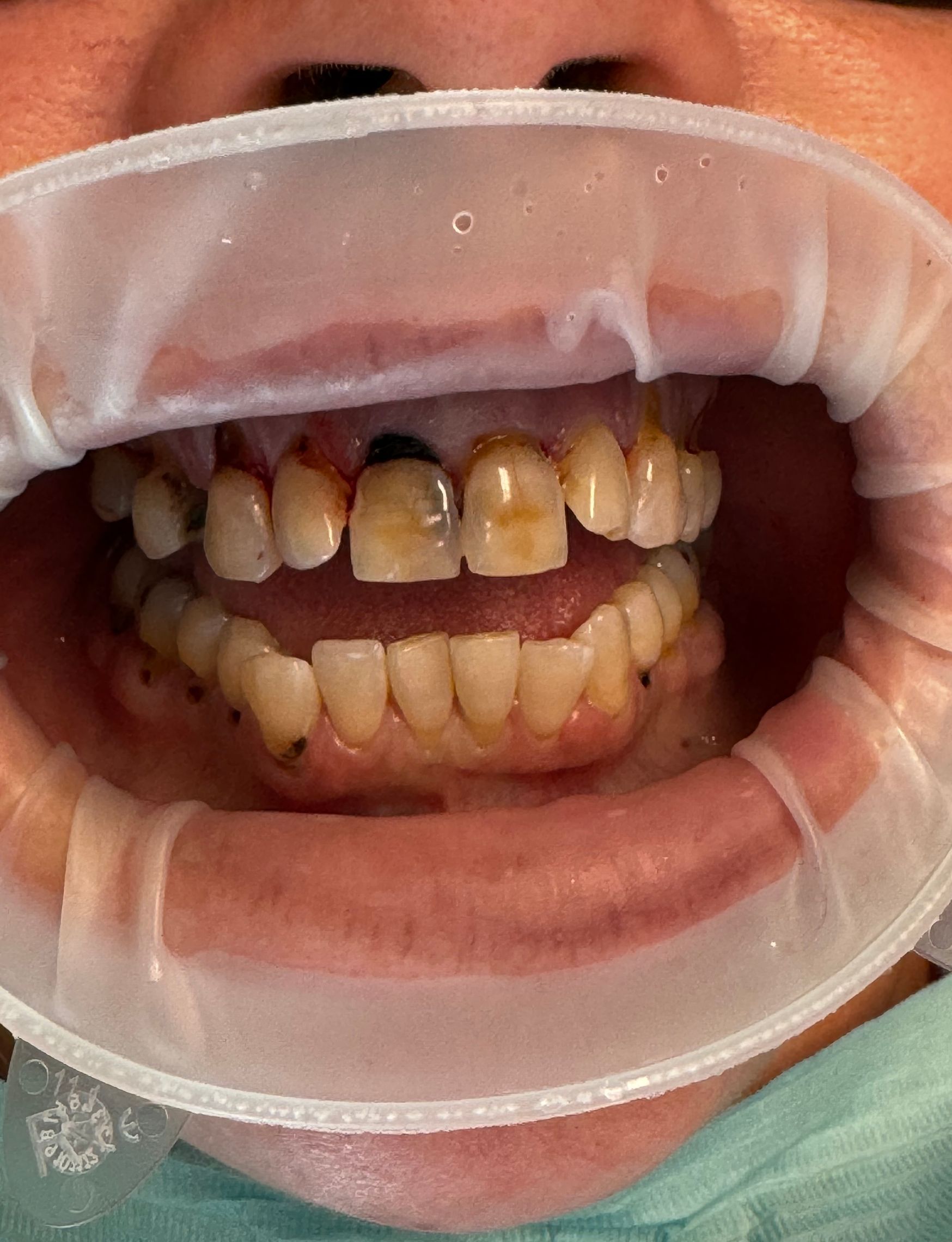 Mouth with dental problems: stained teeth, some decay, held open with a mouth prop.