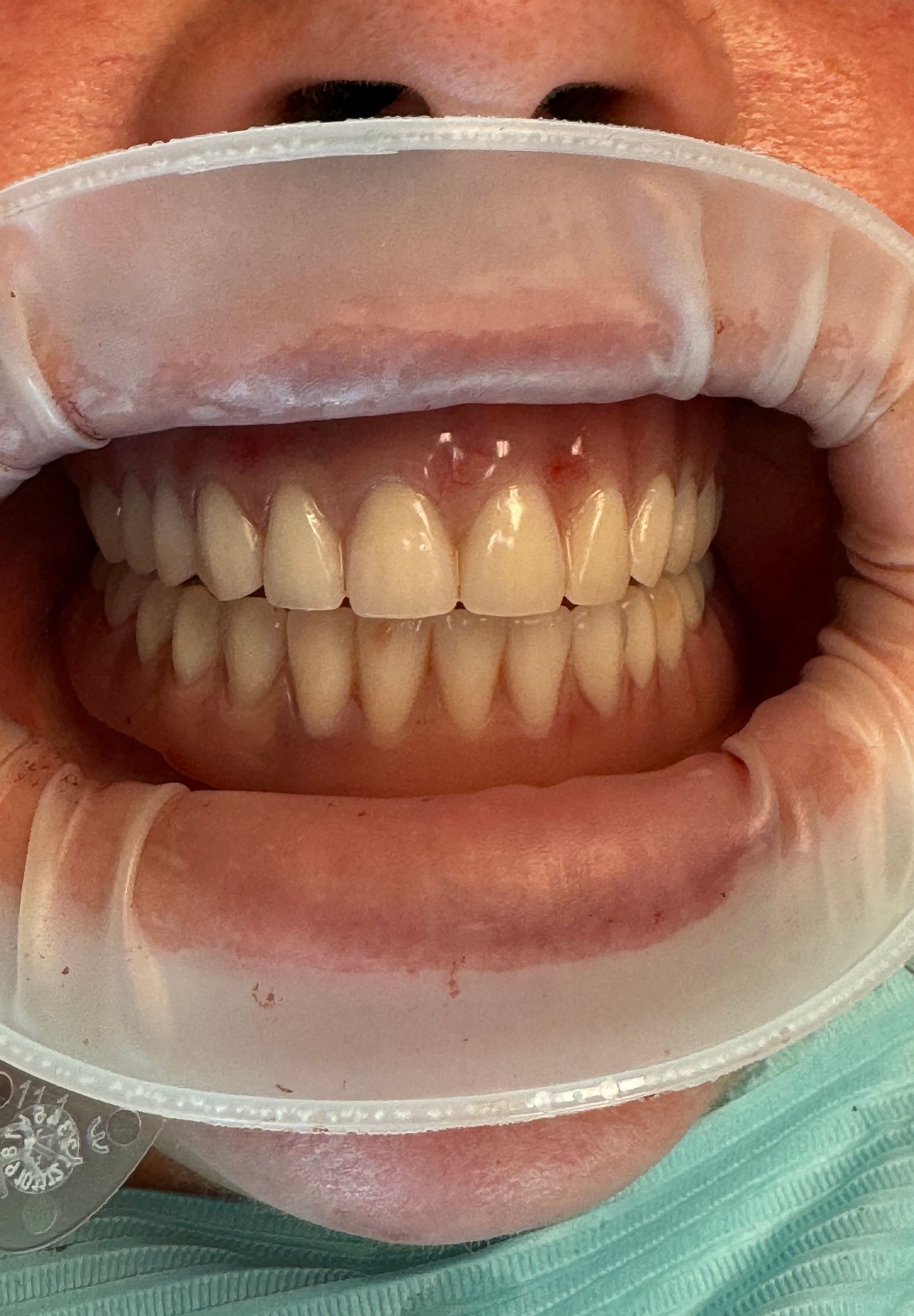 Dentist's view of a mouth with dentures. A cheek retractor holds the lips open.