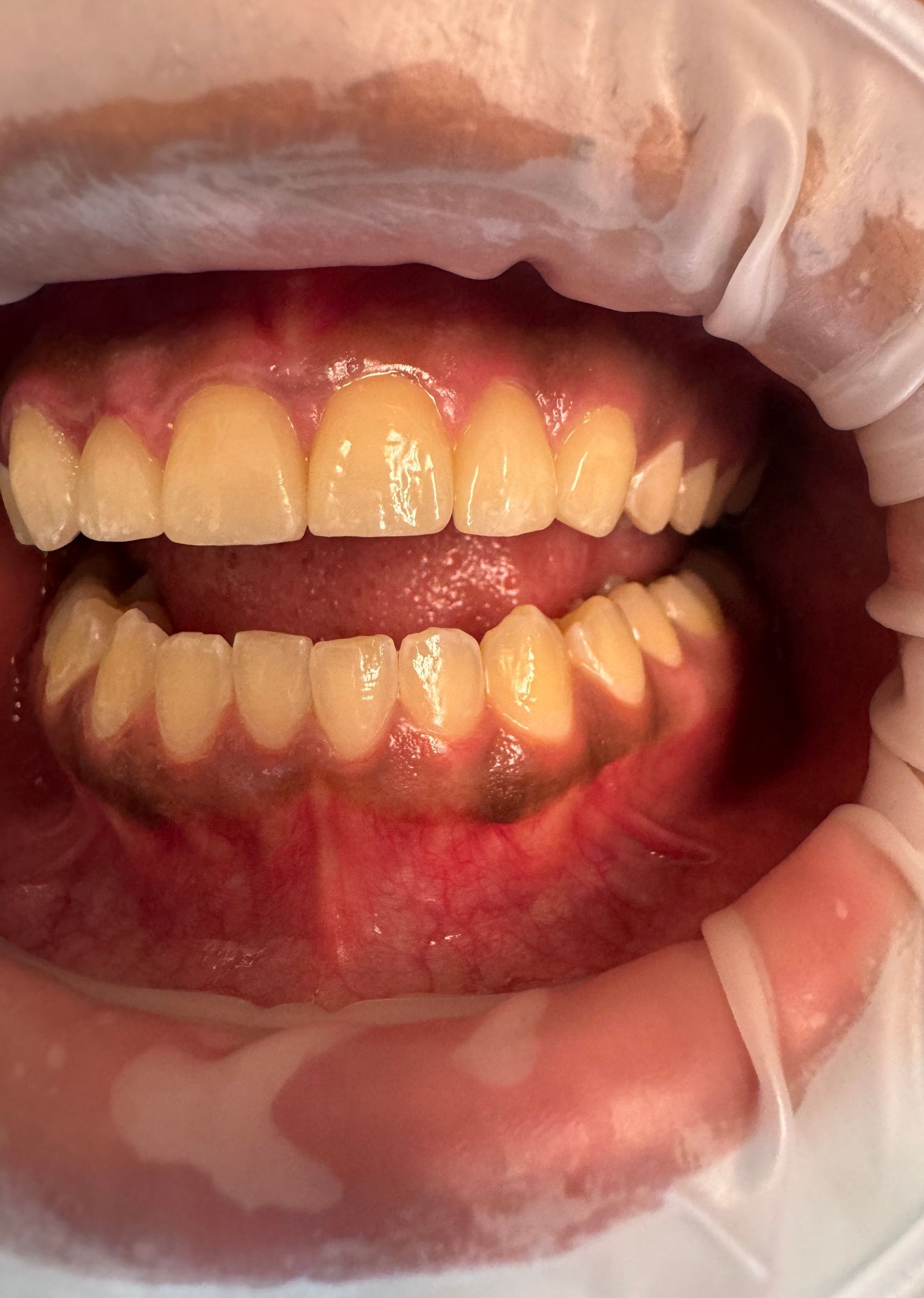 Mouth with teeth, upper teeth appear yellow, lower teeth darker. Gum tissue is red, and the mouth is slightly open.