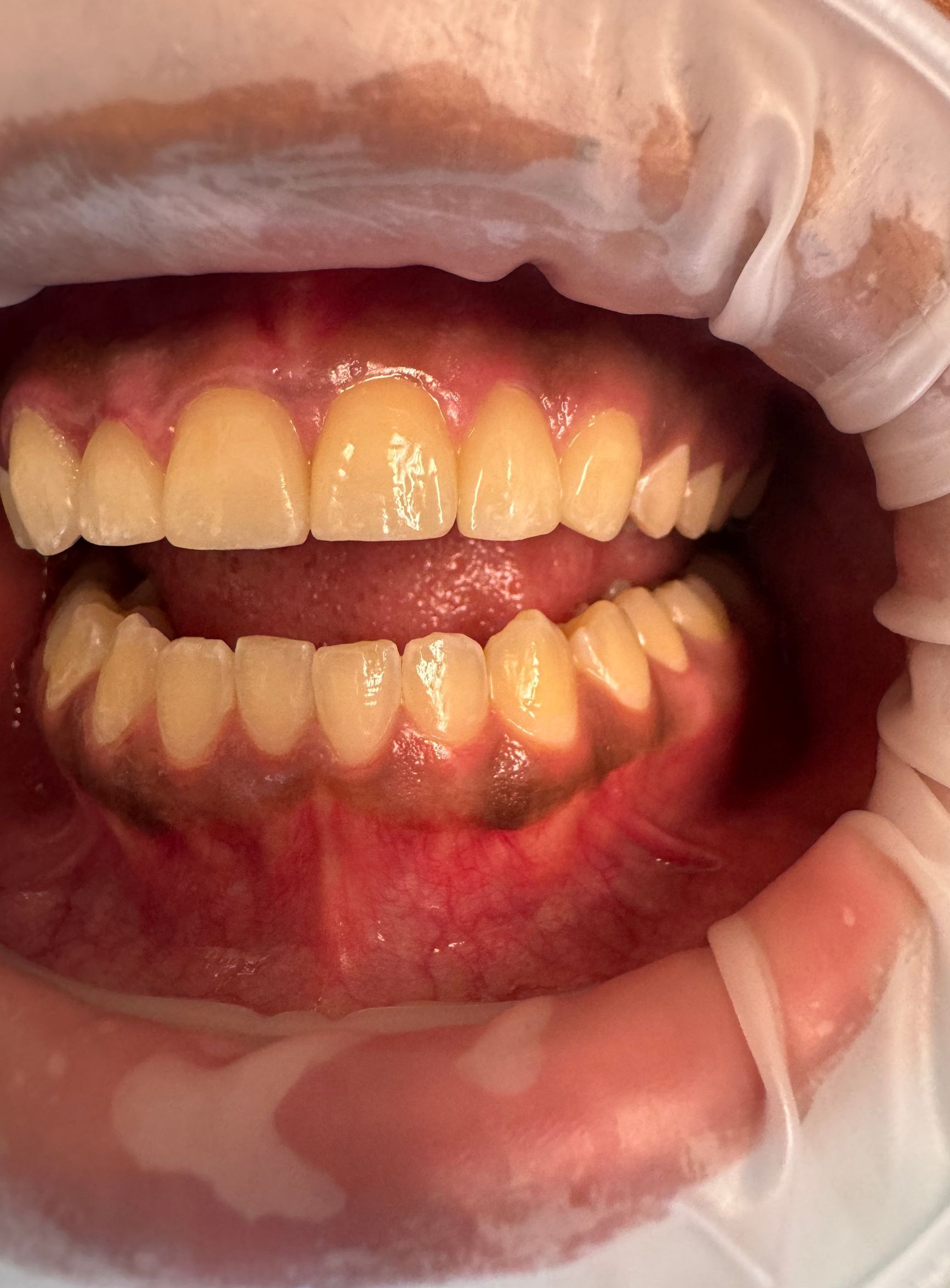 Close-up of teeth inside a mouth, showing yellowed teeth and darker spots on the lower gums.
