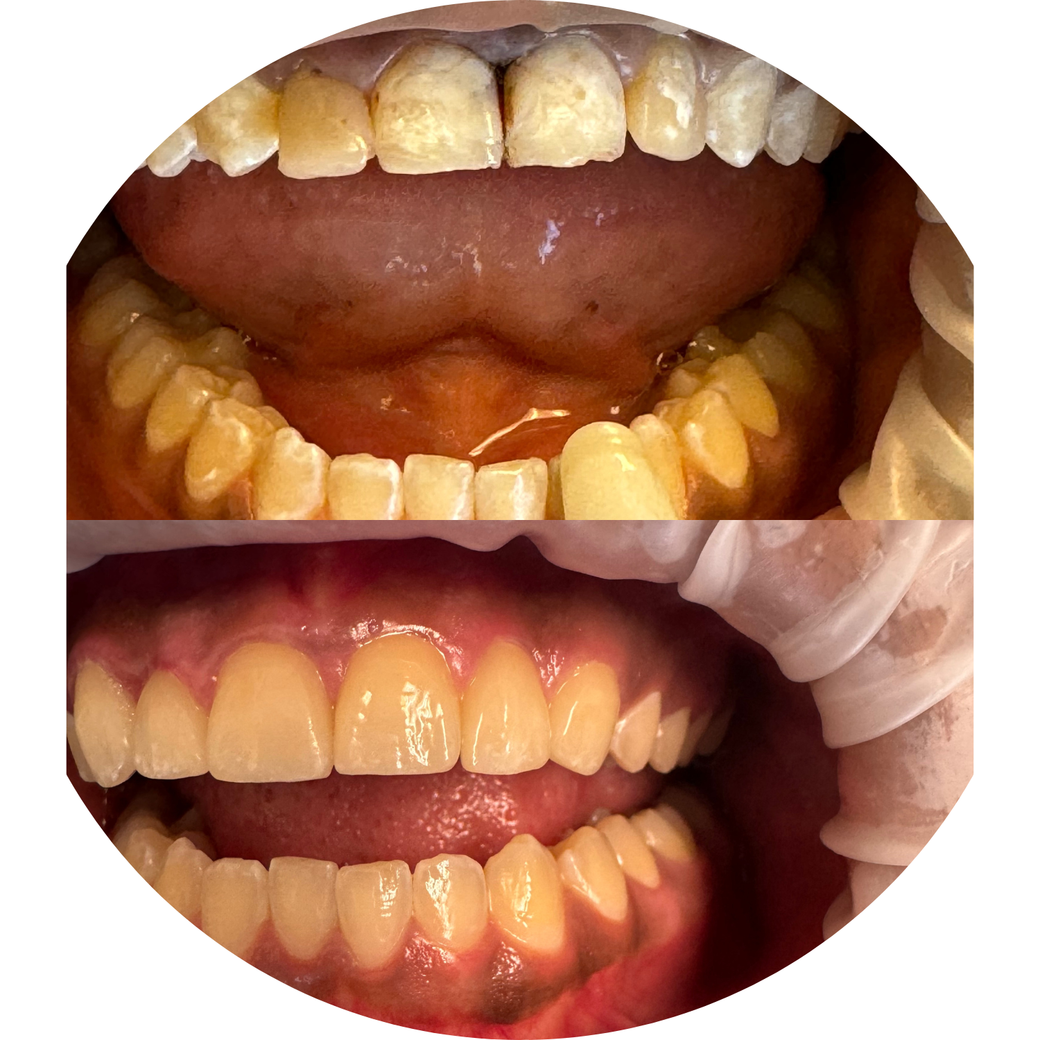Comparison of teeth before and after whitening treatment; teeth are visibly cleaner and brighter after.