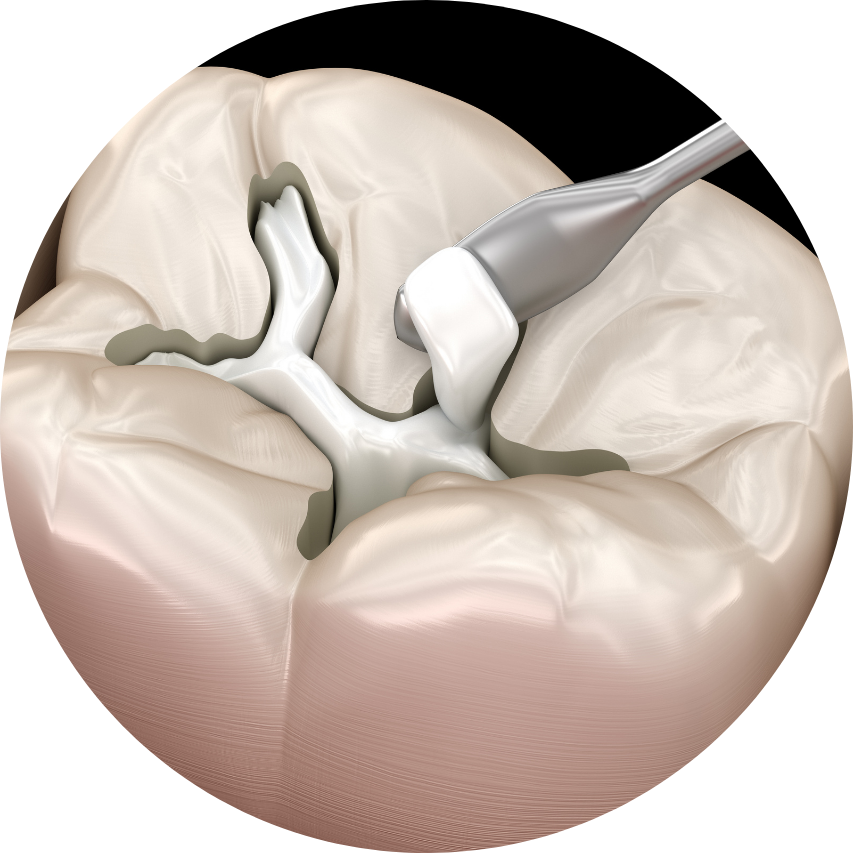 Dental tools applying filling to a tooth cavity.