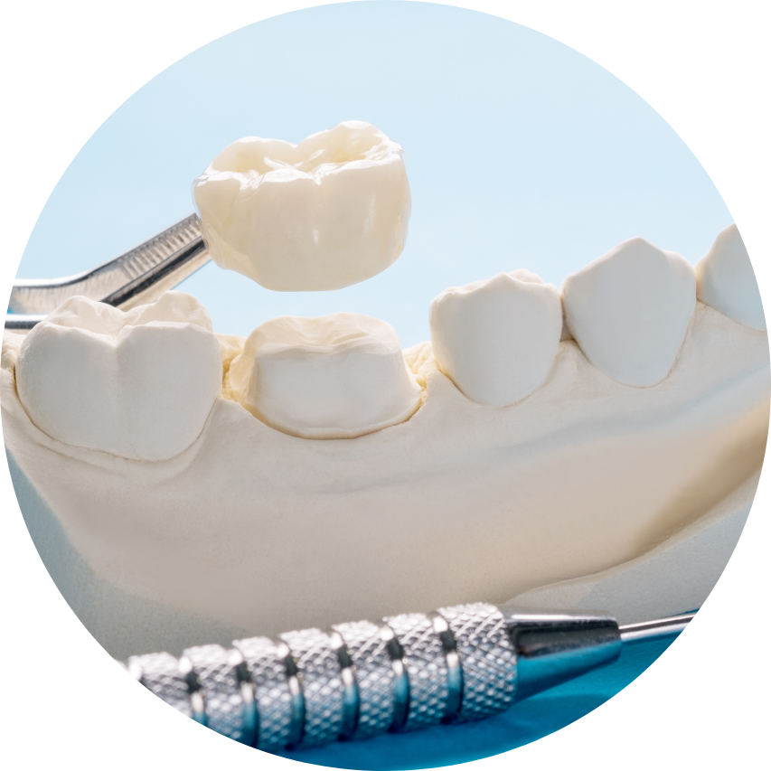 Dental crown being held over a tooth model with dental tools on a blue surface.