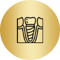 Dental implant illustration showing a screw in the jawbone with a crown.