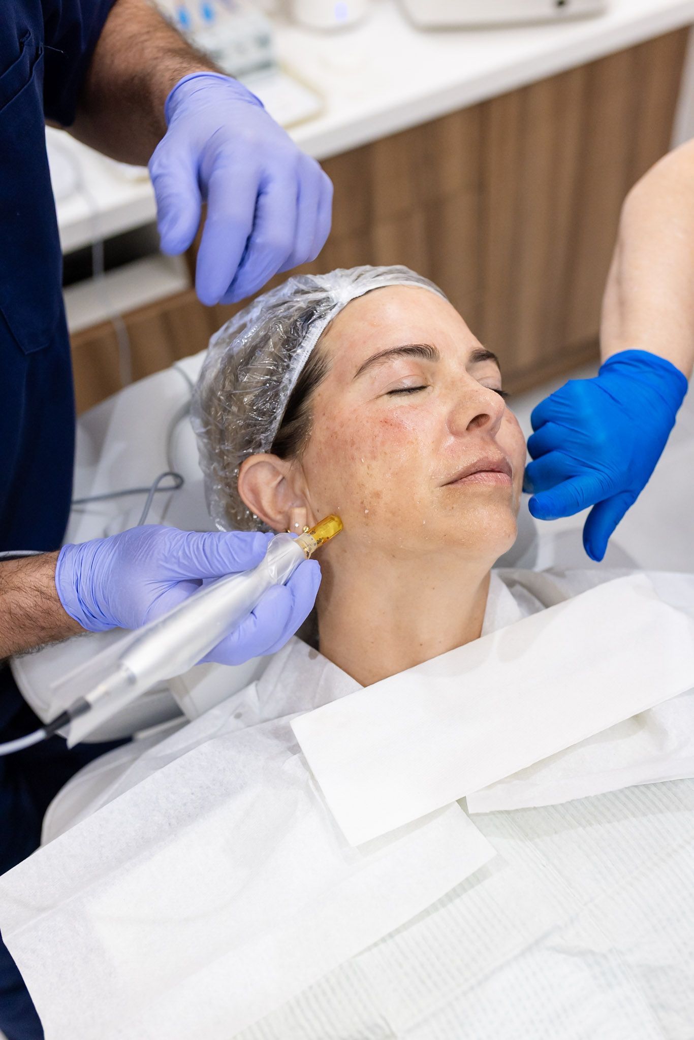 DermaPen microneedling along the jawline with PRF at CARE Esthetics