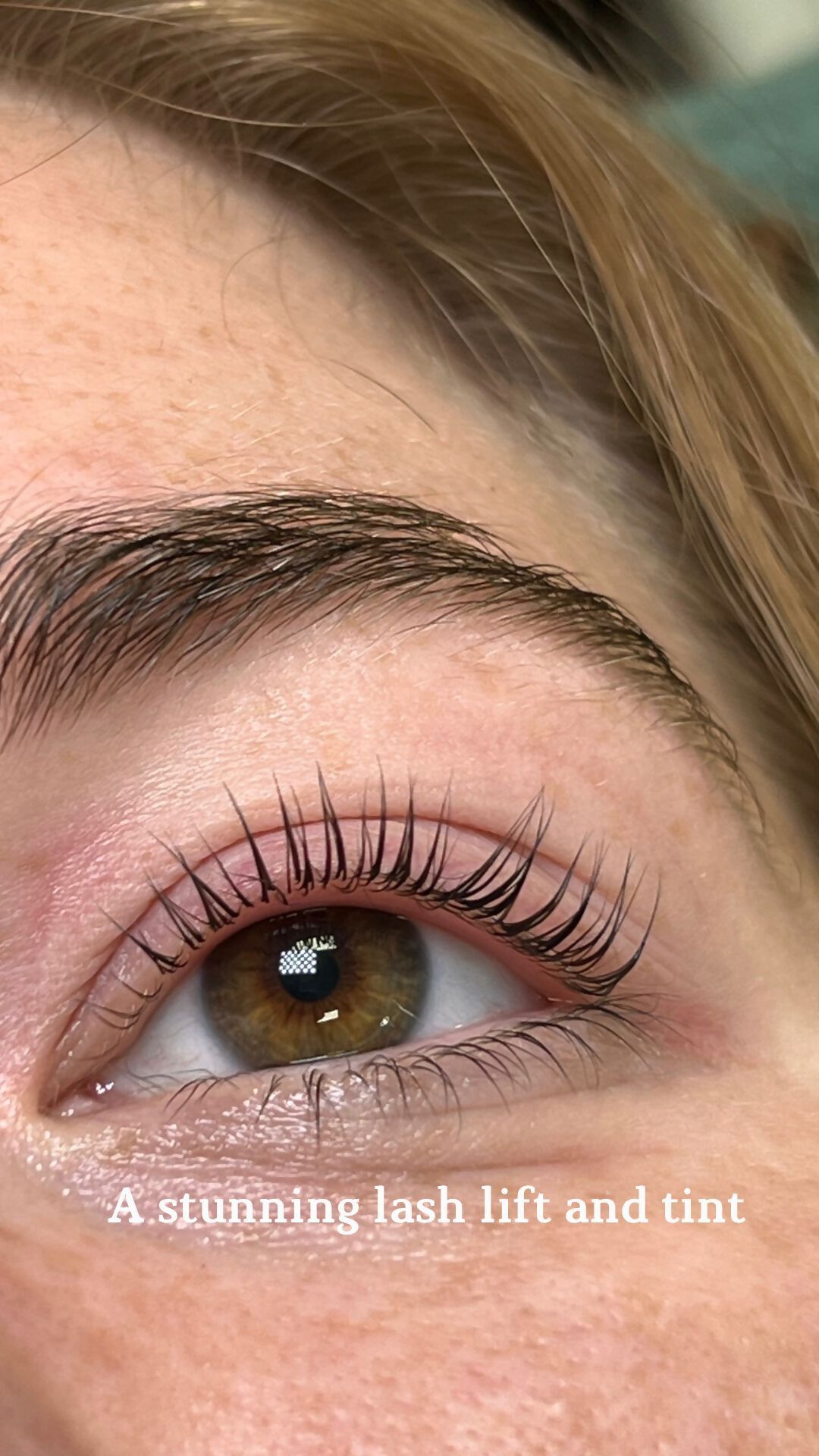 before and after eye treatments