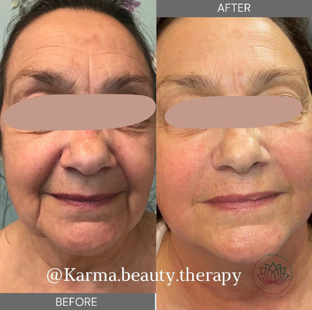 collagen lift