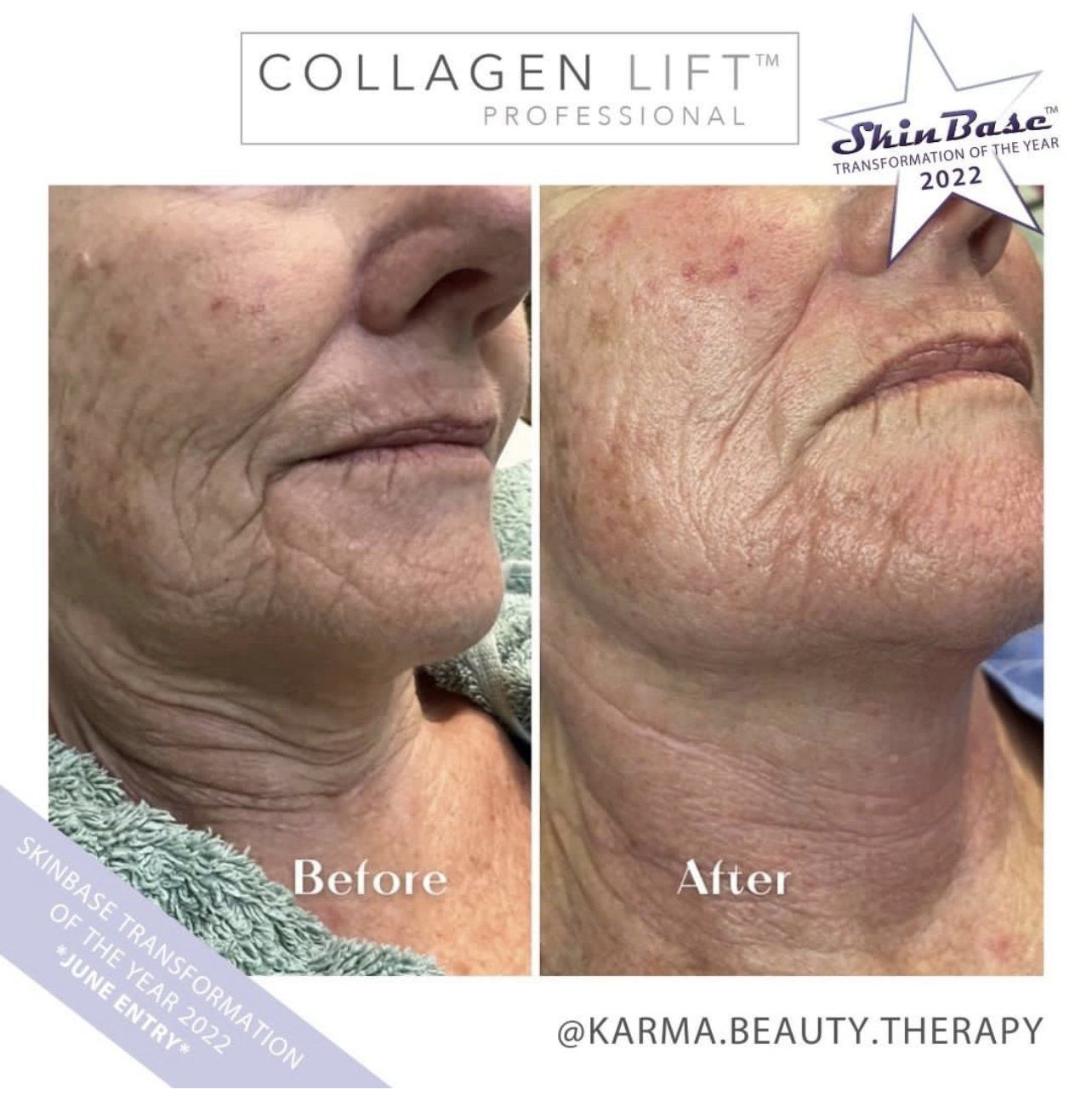 collagen lift
