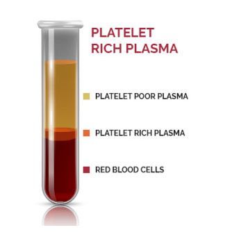 Platelet Rich Plasma