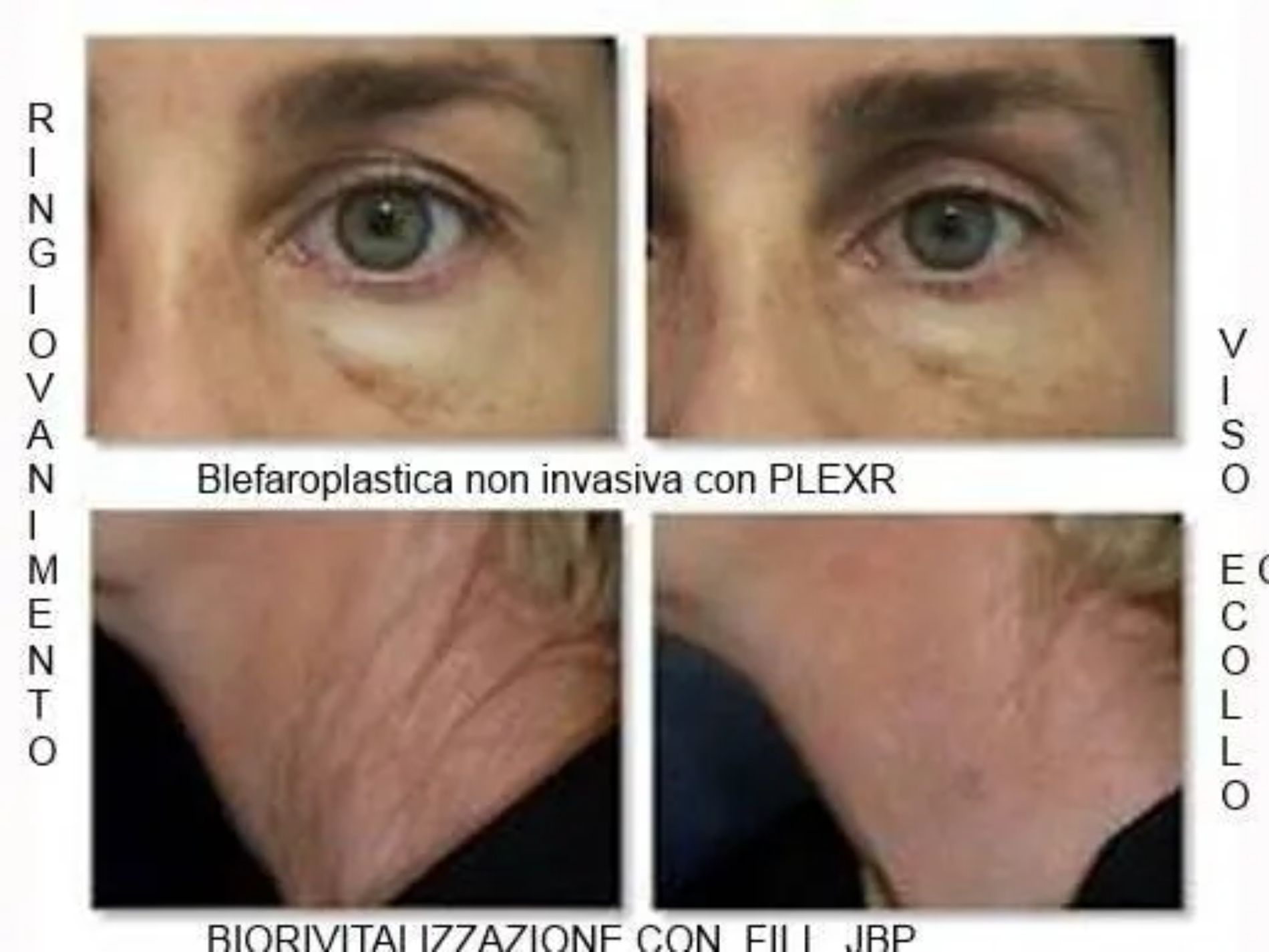 prima e dopo plexr
