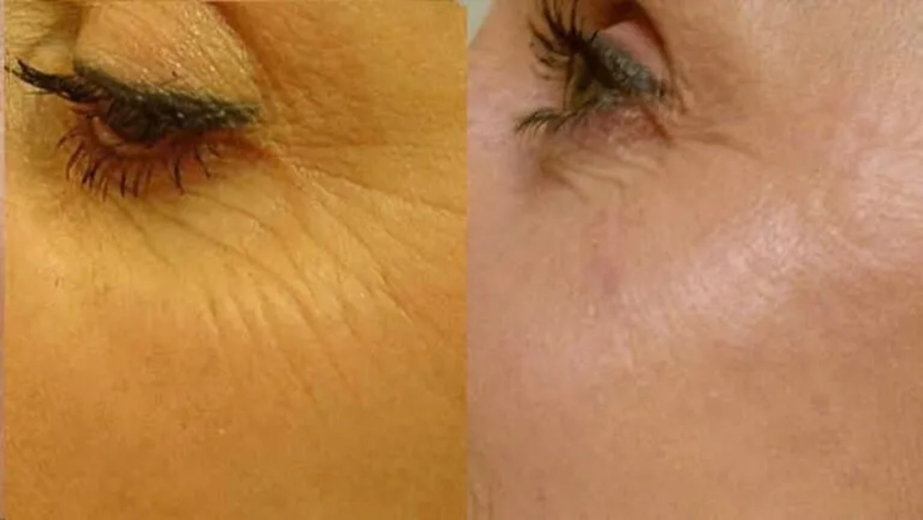 prima e dopo filler