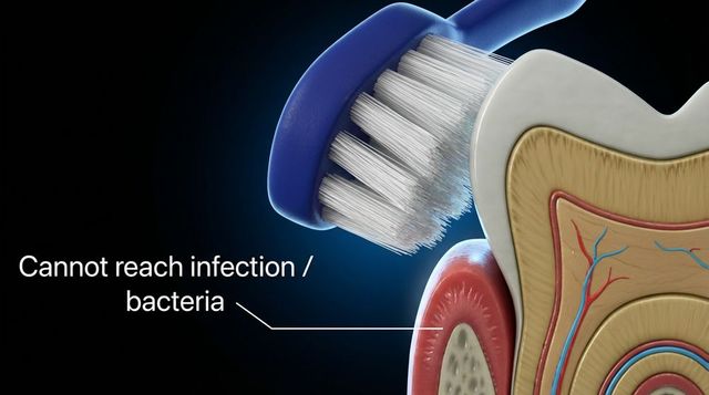 Perio Defend Periodontal Tray Therapy | Bayshore Dental Studio
