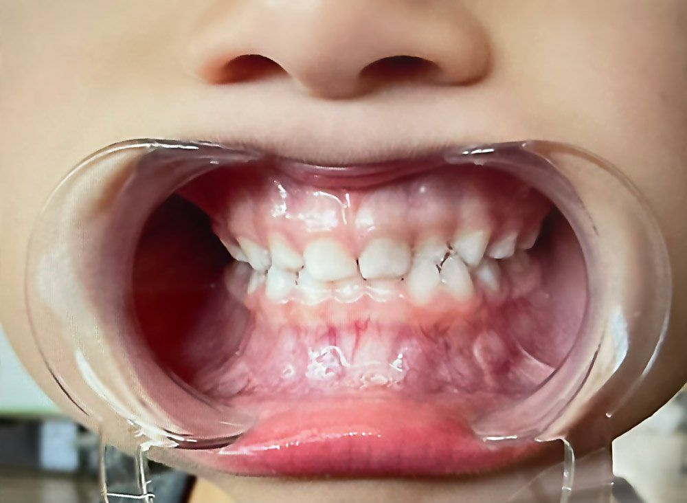 myo mouth guard