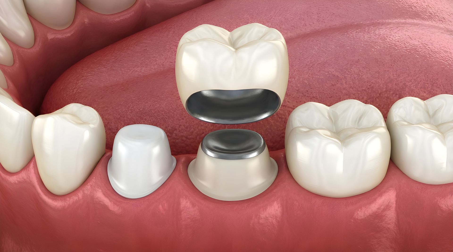 Dental implant diagram with a screw and crown between pink gums and white teeth