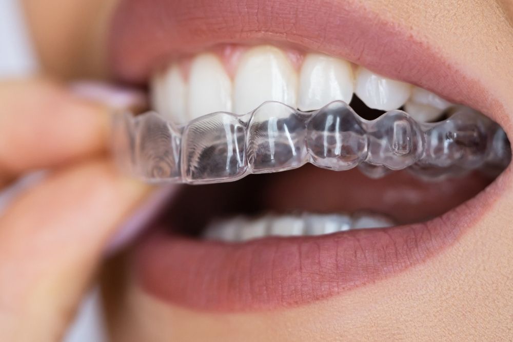 Close-up of a person putting a clear aligner tray onto their upper teeth, visible lips.
