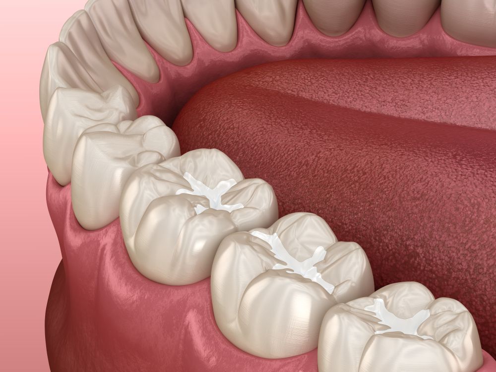 Close-up of molars with white dental fillings in a pink mouth.