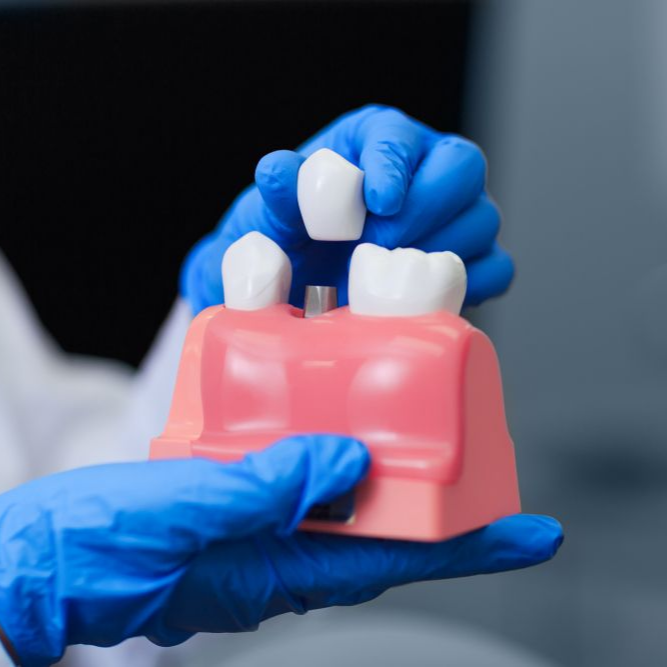 Hands in blue gloves holding a dental model with teeth.