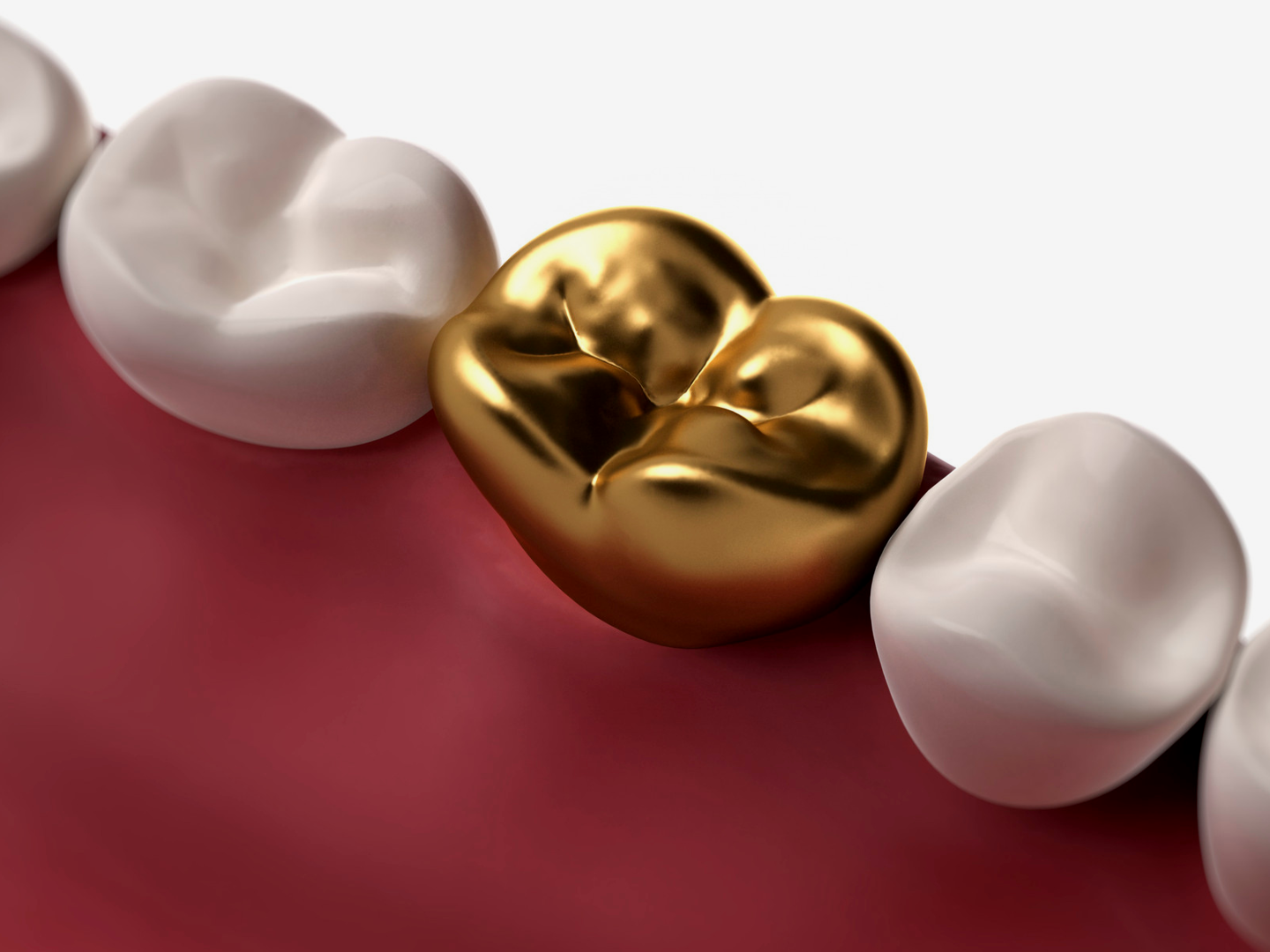 Dental crowns on pink gums, including a shiny gold crown between white crowns