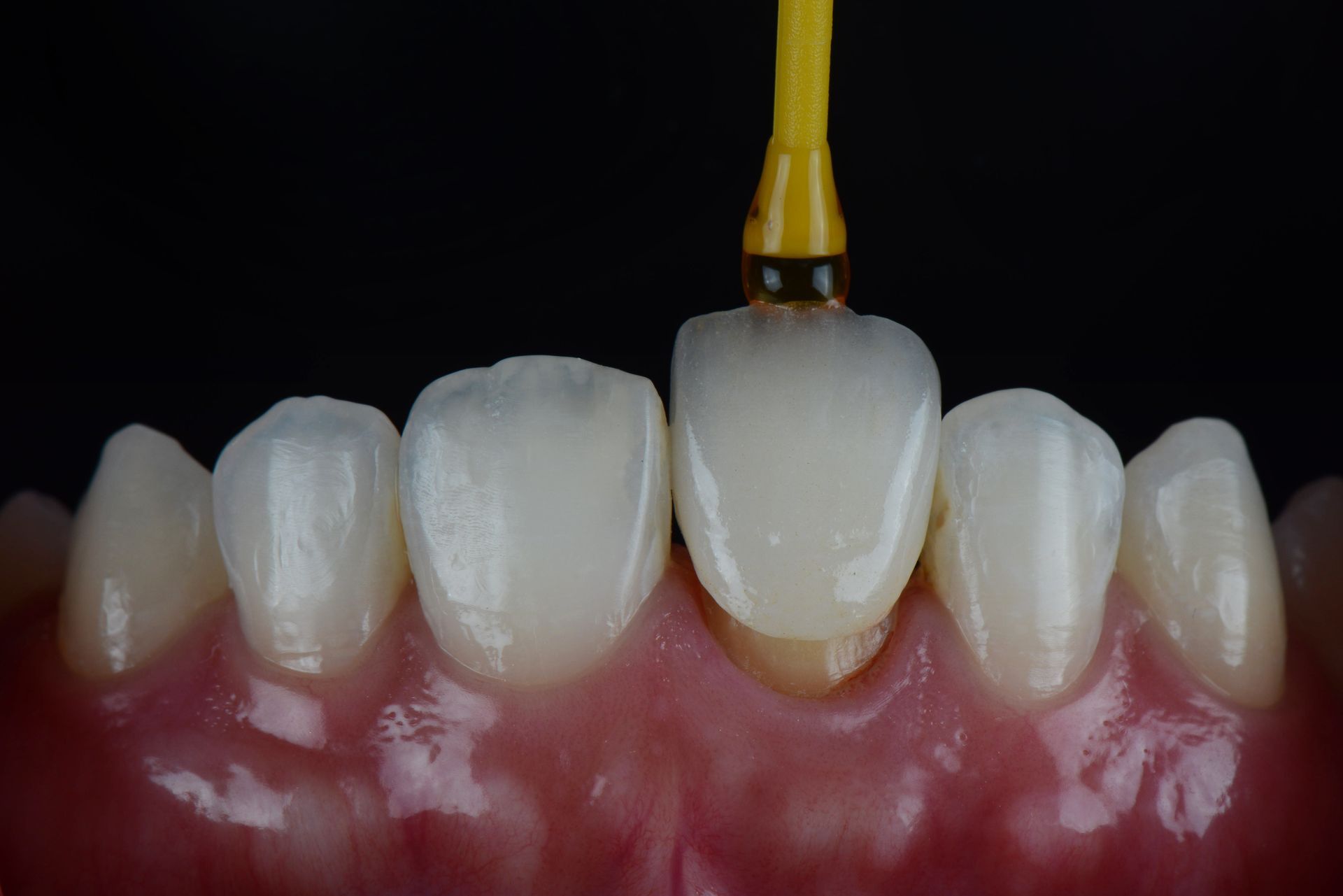 Tooth shade guide placed on front teeth to compare color