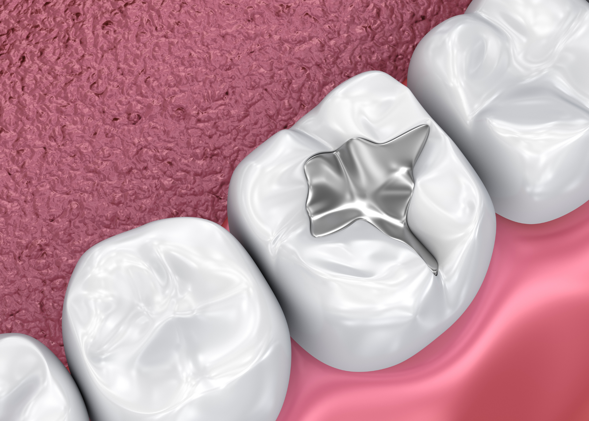 Close-up of teeth, one with a silver dental filling. Pink gums and surrounding teeth visible.