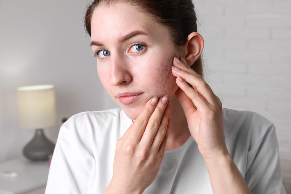A woman is looking at her acne on her face — Sibina Cosmetic Tattoo Art In Broadbeach, QLD