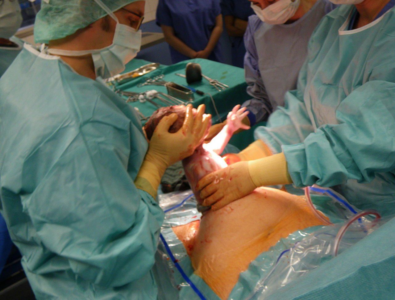 v back c section neck torticollis baby chiropractor