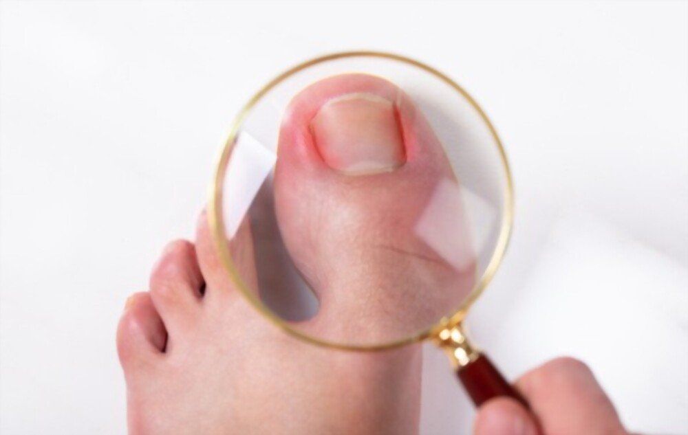 Quais são os sintomas das unhas encravadas Quais são os sintomas das unhas encravadas?