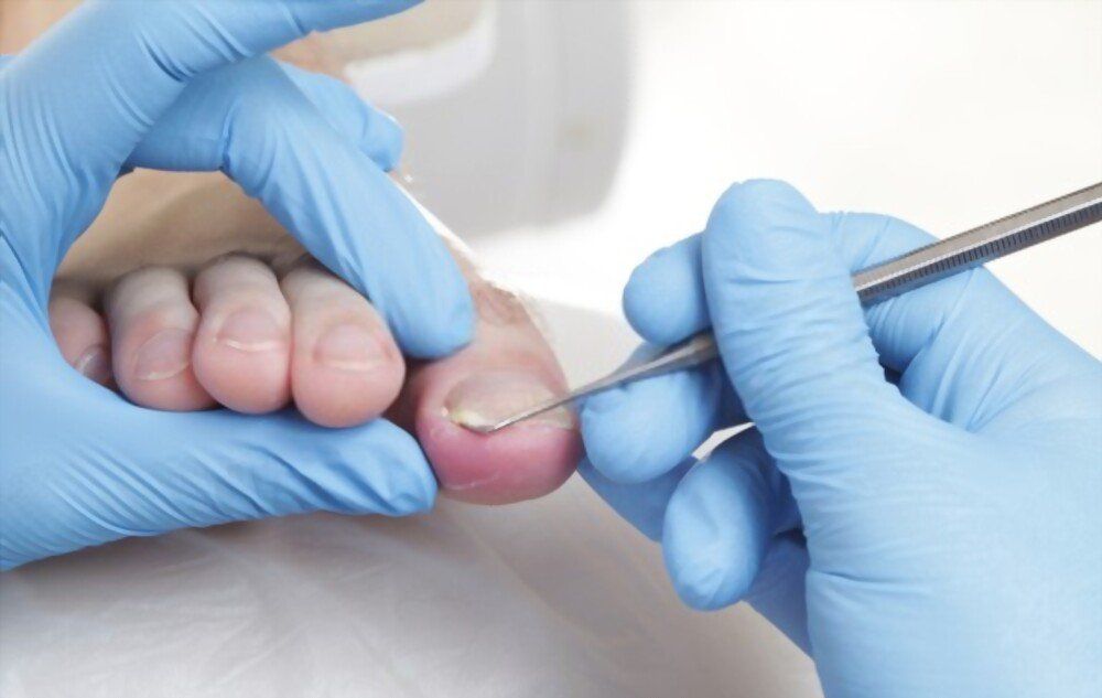 O que causa unhas encravadas O que causa unhas encravadas?