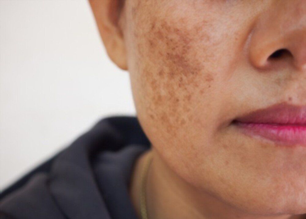 O que causa melasma O que causa melasma?