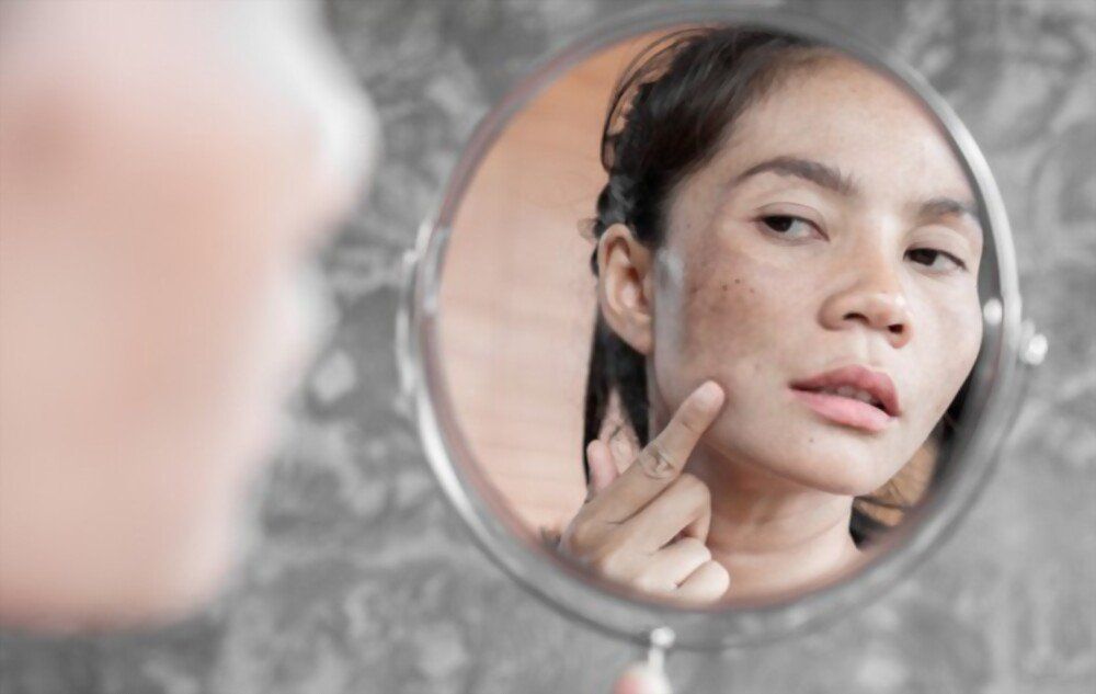 Dermatologista especialista em melasma em Chapecó