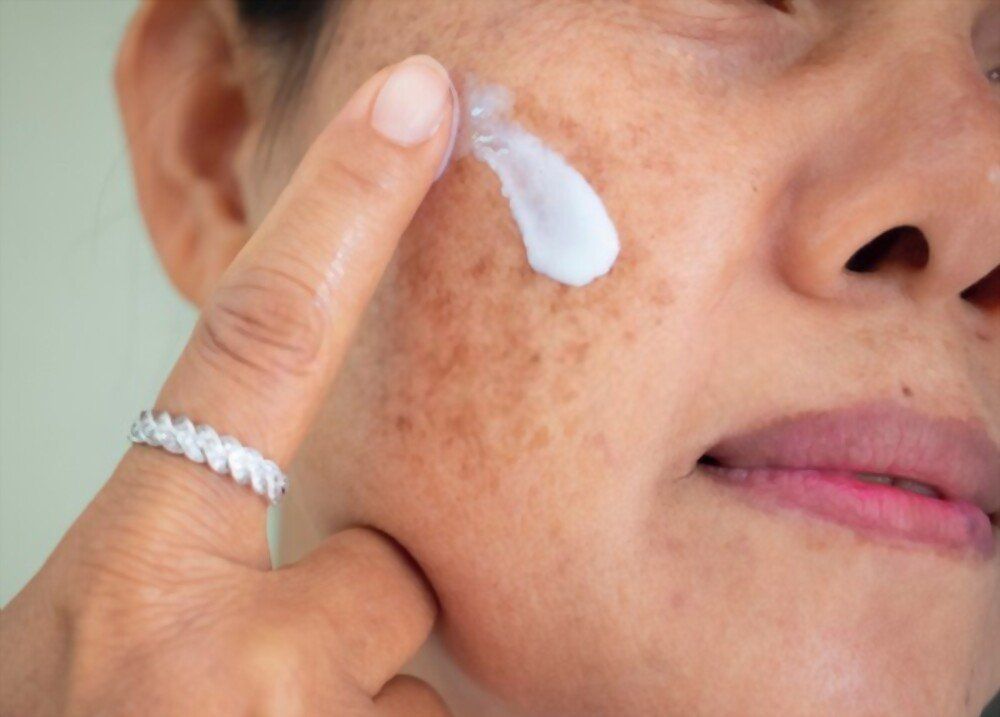 Tratamento para melasma em Chapecó Tratamento para melasma em Chapecó