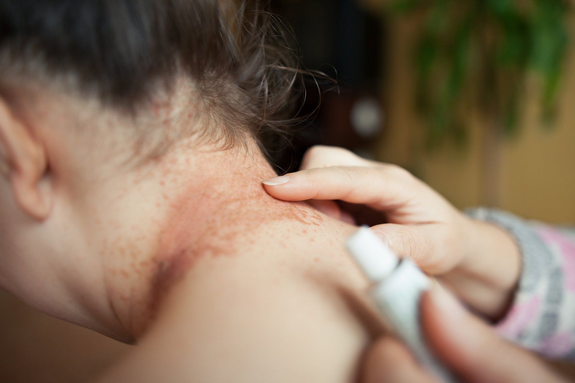 tratamento para dermatite atópica tratamento para dermatite atópica