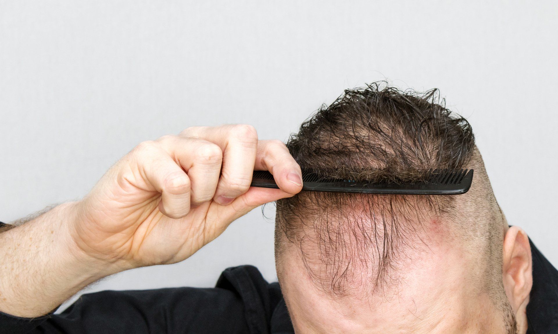 Como tratar alopecia capilar em Chapecó?