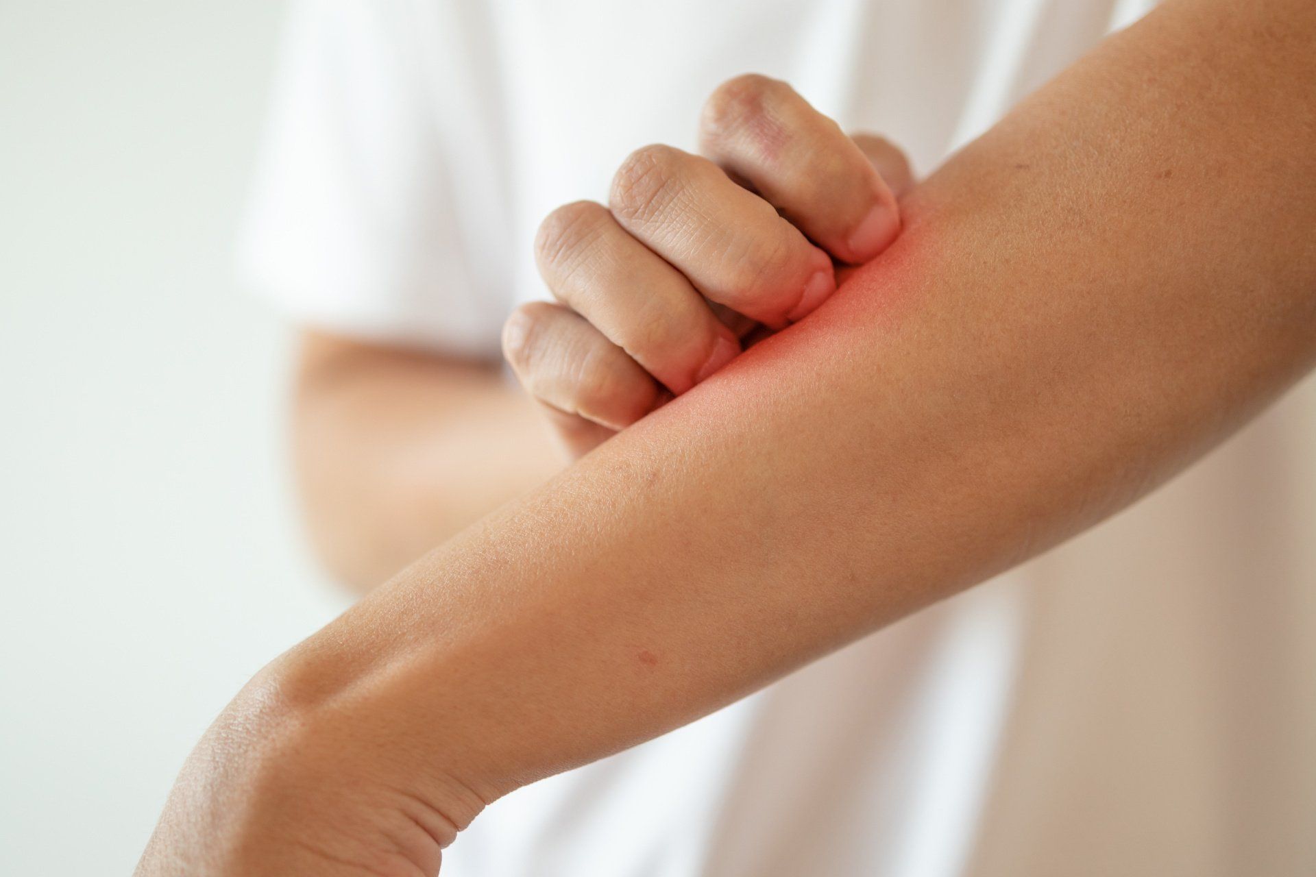 sintoma da dermatite atópica sintoma da dermatite atópica