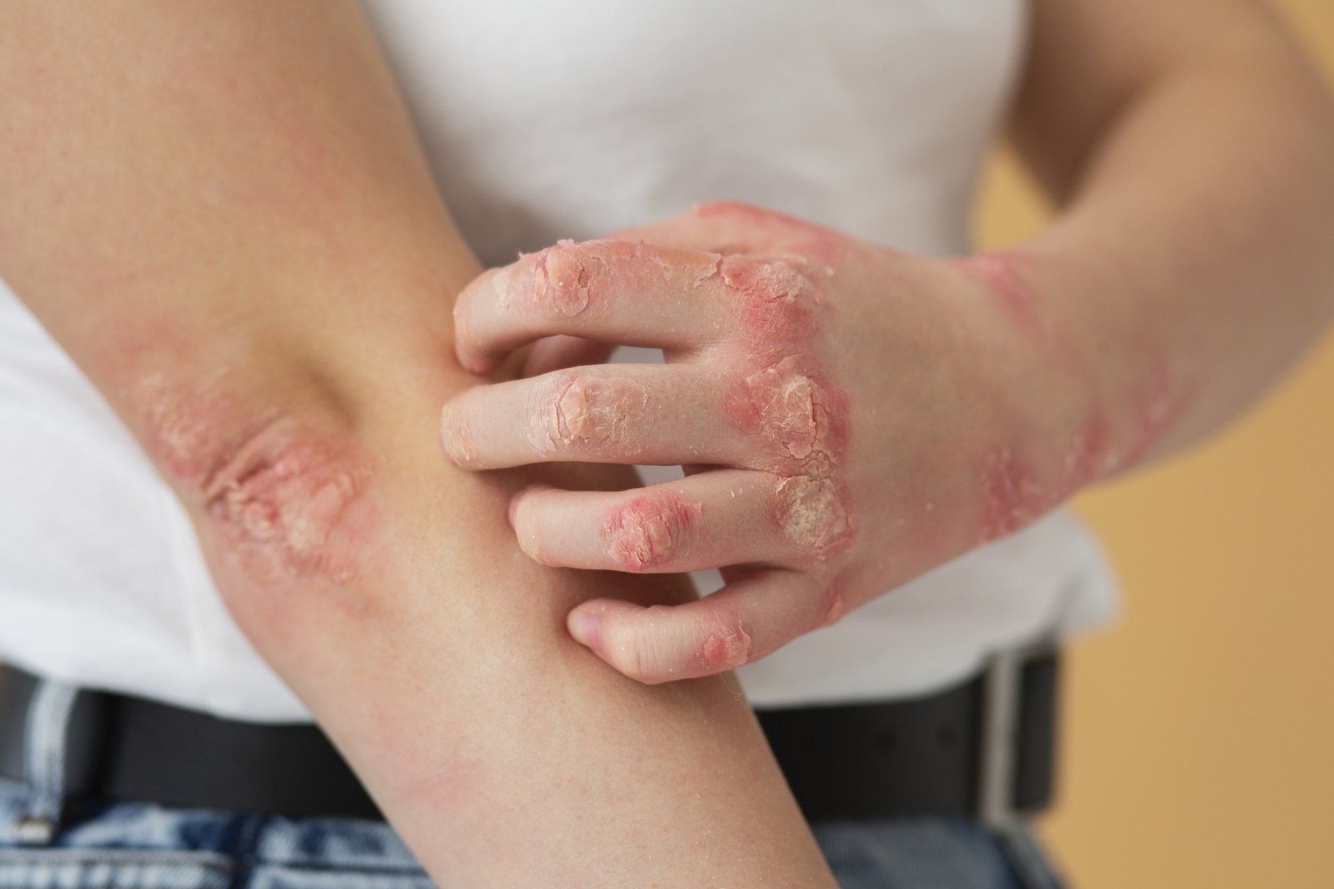 Eczema Eczema