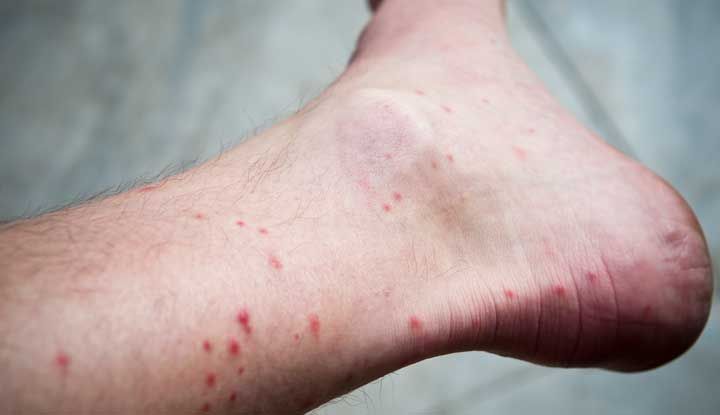 Foot and Ankle With Several Flea Bites — NatureWise Pest Control In Port Macquarie, NSW