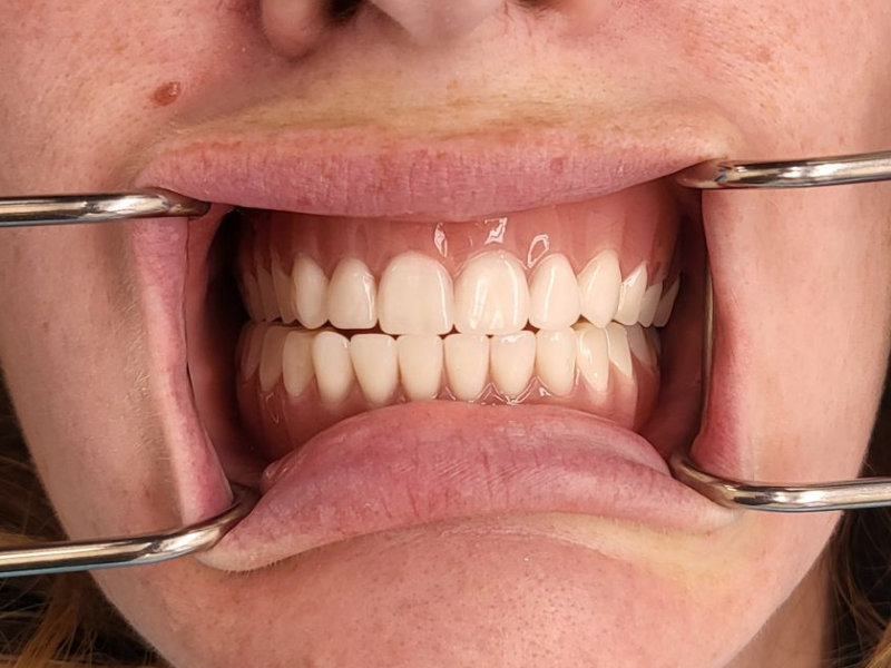 Dental Implant After