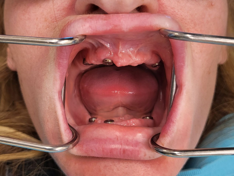 Dental Implant Before