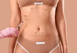 Doctor injecting marked abdomen for cosmetic procedure