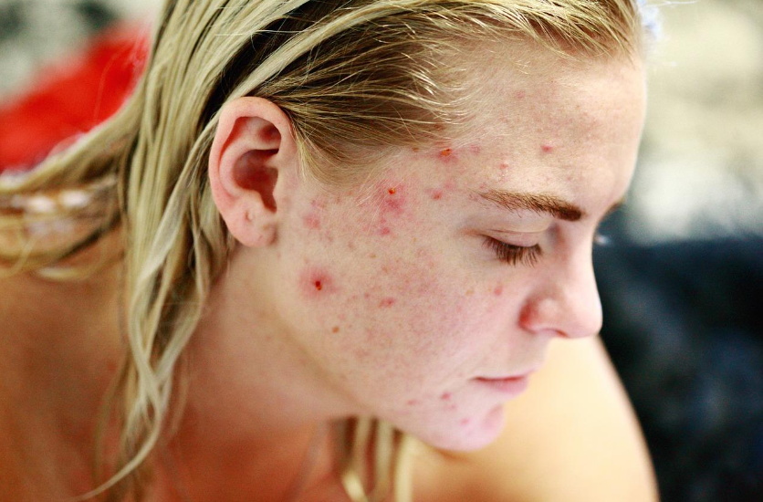 Acne in Adults | Pine Belt Dermatology