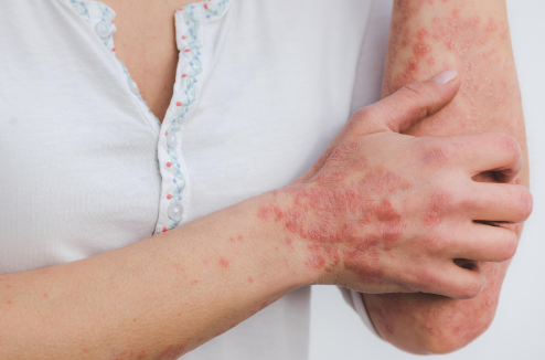 Beyond Acne: Understanding and Treating Adult Skin Conditions | Pine Belt Dermatology