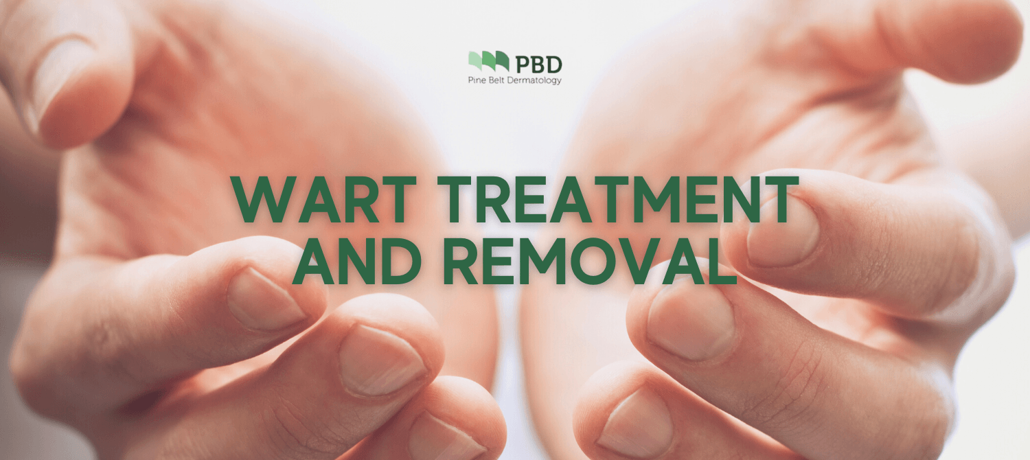 Wart Treatments and Removal | Pine Belt Dermatology