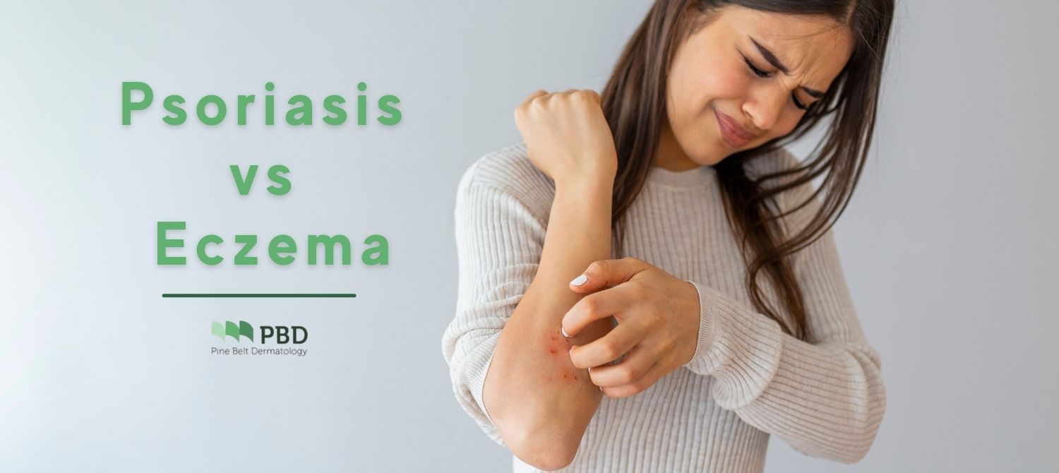 woman with psoriasis on arm