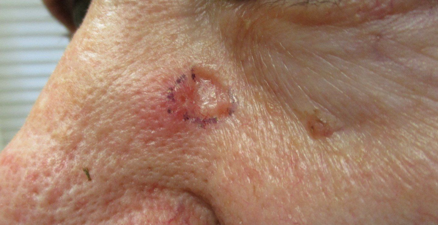 Basosquamous Carcinom | Pine Belt Dermatology