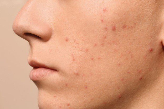 What is Acne Conglobata | Pine Belt Dermatology
