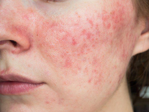 Signs of Rosacea | Pine Belt Dermatology