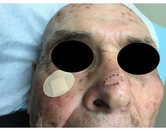 Identifying the Basal Cell Carcinoma | Pine Belt Dermatology