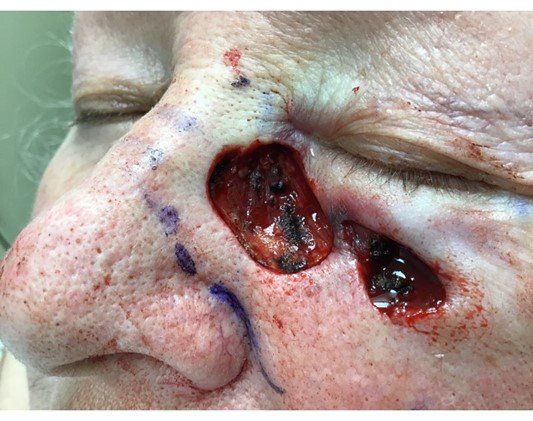 Basosquamous Carcinom Under Eye | Pine Belt Dermatology