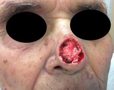 Infiltrative Basal Cell | Open Wound | Pine Belt Dermatology