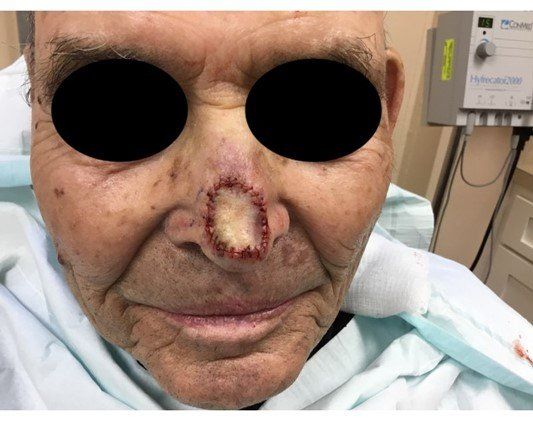 Basal Cell Carcinoma Immediately 